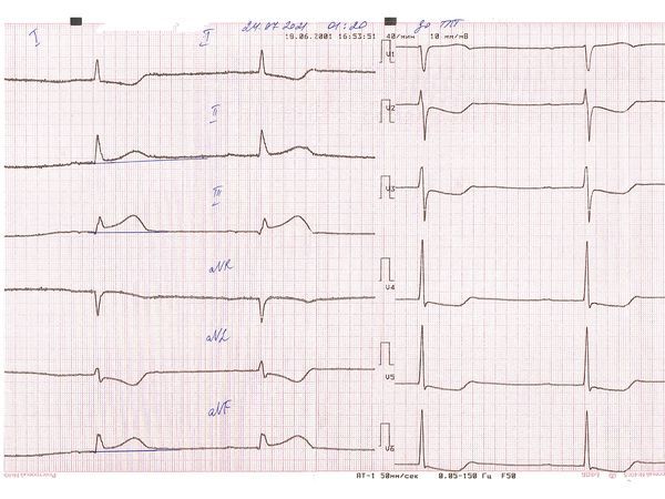 ЭКГ до тромболитической терапии