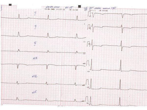 ЭКГ через 30 минут после тромболитической терапии
