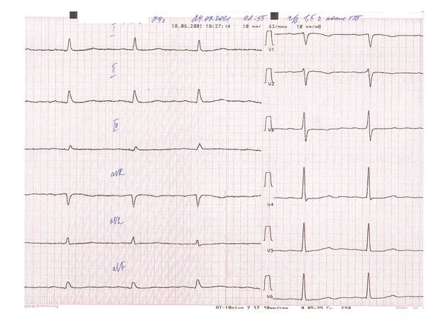 ЭКГ через полтора часа после тромболитической терапии