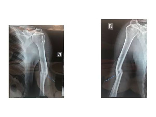 Сращение кости через пять месяцев после травмы