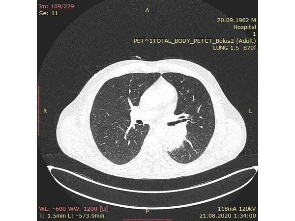 ПЭТ-КТ лёгких