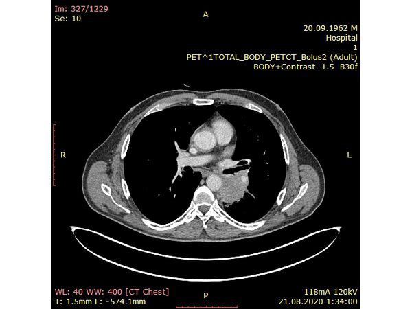 ПЭТ-КТ грудной клетки