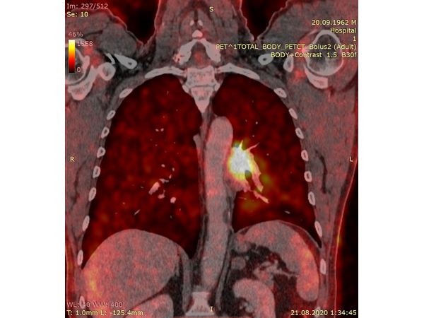 ПЭТ-КТ (наложение, корональный срез)