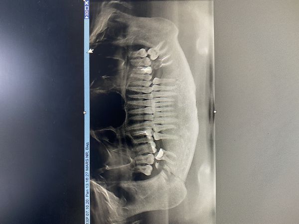 Ортопантомограмма нижней челюсти