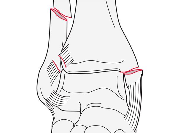 AO Classification 44C1.2 (простой перелом диафиза малоберцовой кости с переломом медиальной лодыжки)