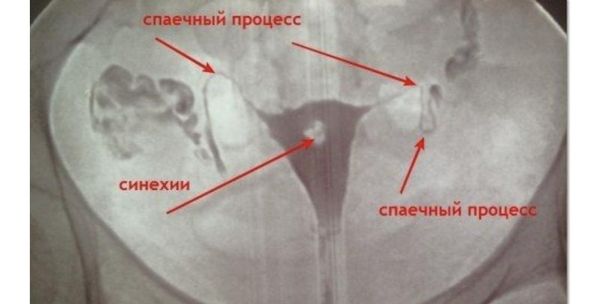 Спаечный процесс на МРТ