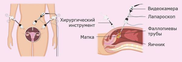 Лапароскопия