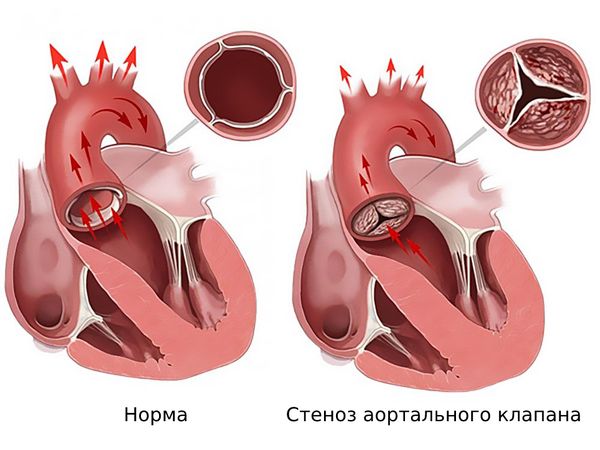 Аортальный стеноз