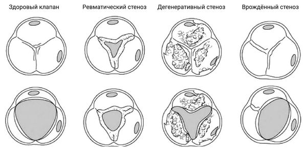 Виды стеноза