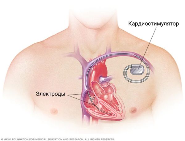 Кардиостимулятор