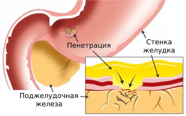 Пенетрация язвы желудка