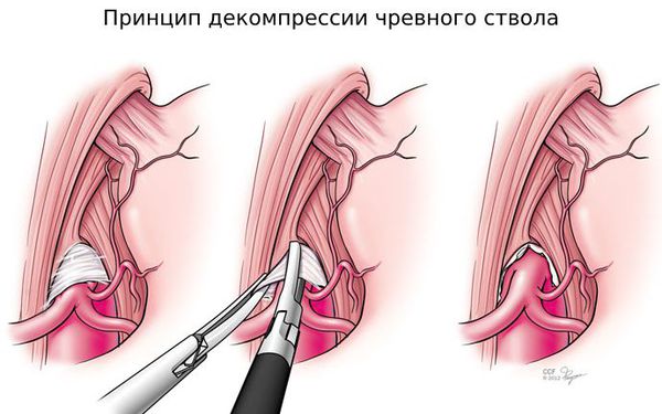 Принцип декомпрессии чревного ствола