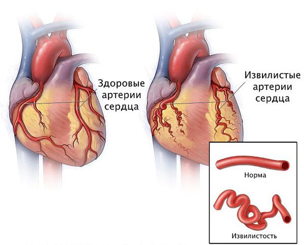 Патологическая извилистость коронарных артерий