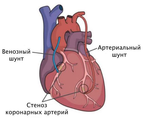 Шунтирование