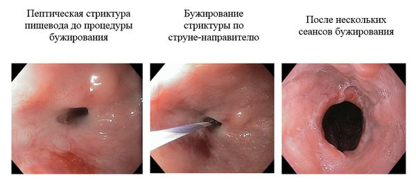 Механическая дилатация 