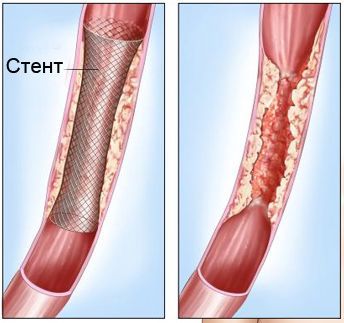 Стентирование