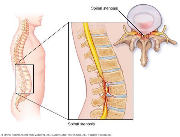 Спинальный стеноз поясничного отдела позвоночника