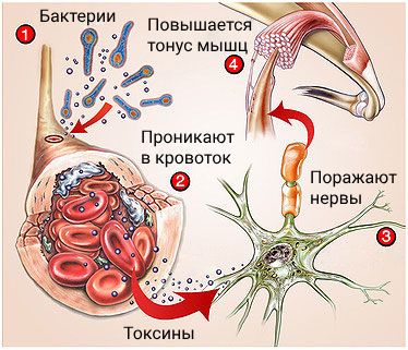 Как развивается столбняк