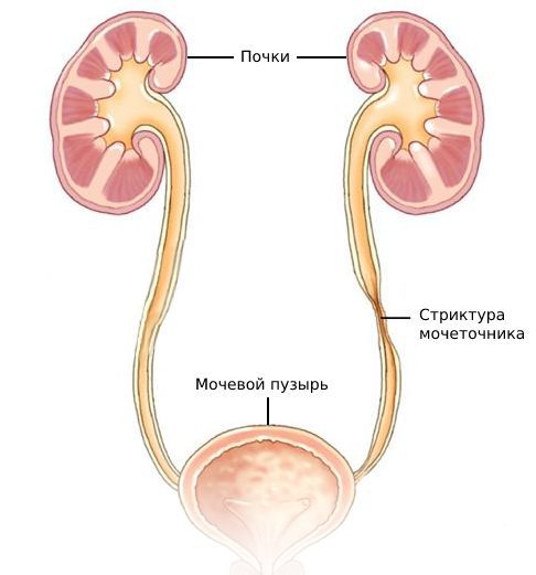 Стриктура мочеточника