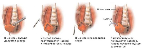 Метод Psoas hitch