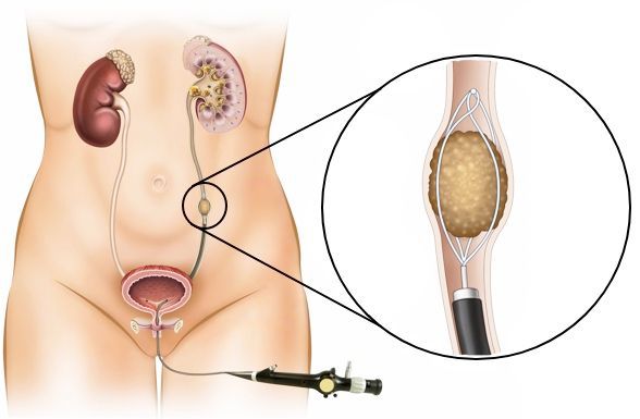 Удаление камня из мочеточника с помощью уретроскопии