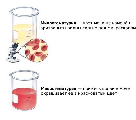 Микро- и макрогематурия