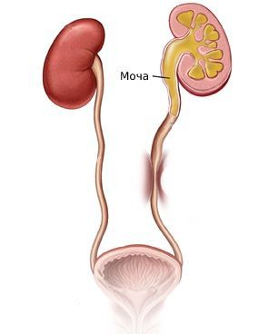 Затруднение оттока мочи при стриктуре мочеточника