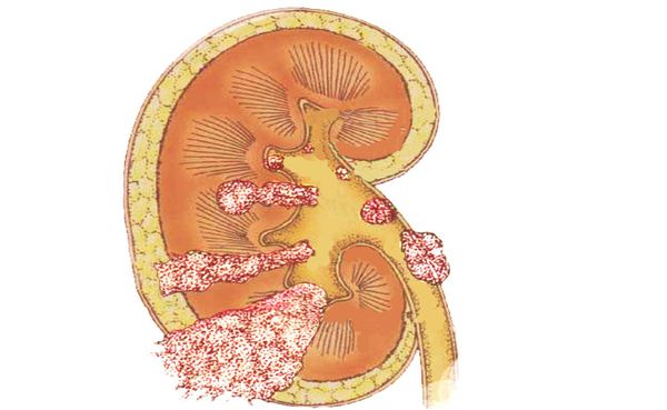 Рак почечной лоханки