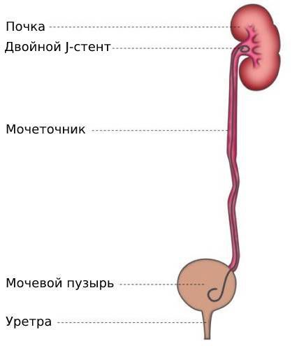 Стентирование мочеточника двойным J-стентом 