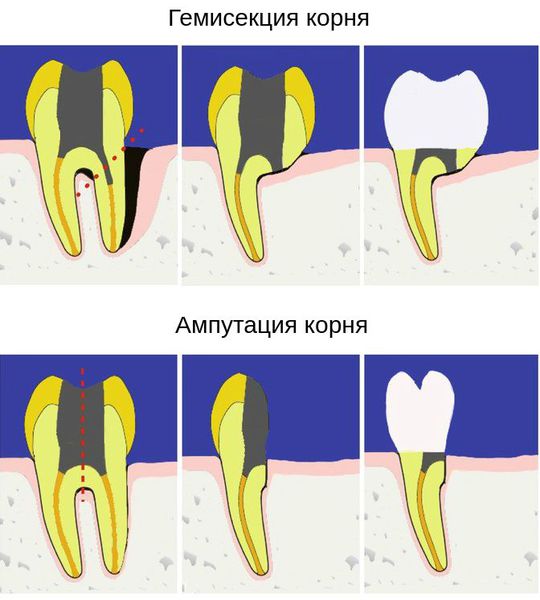 Гемисекция и ампутация корня