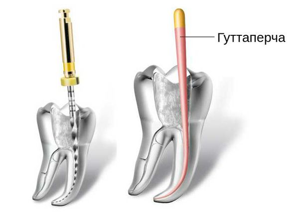Пломбирование канала гуттаперчей