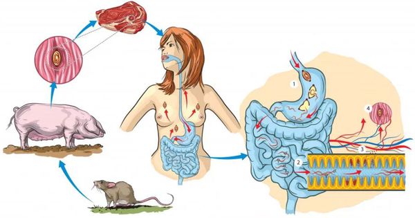 Кишечная и мышечная фаза трихинеллёза