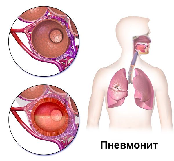 Пневмонит