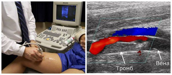Дуплексная ультрасонография нижних конечностей