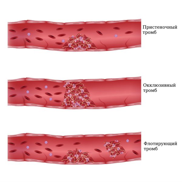 Классификация по степени фиксации проксимальной части тромба к венозной стенке