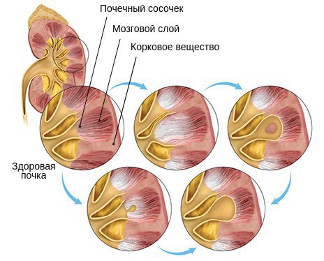 Туберкулёзный папиллит