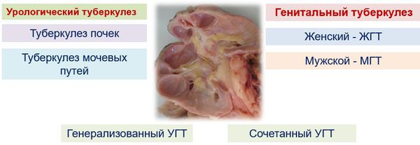 Классификация урогенитального туберкулёза