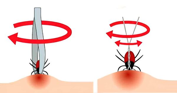 Удаление клеща пинцетом и ниткой
