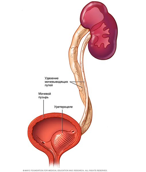 Удвоение мочевыводящих путей 