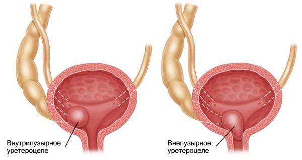 Внутрипузырное и внепузырное уретероцеле