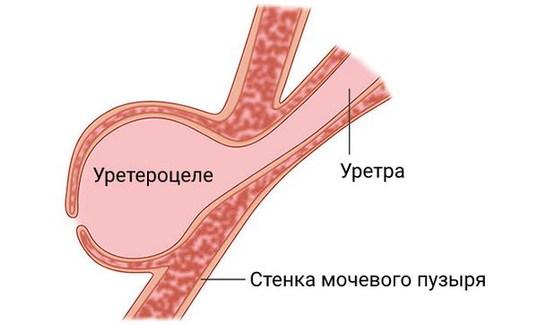 Уретероцеле