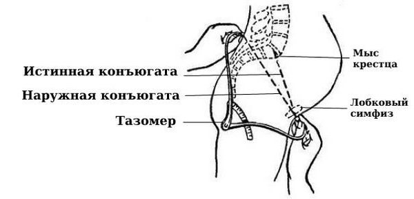 Измерение таза: истинная и наружная конъюгата