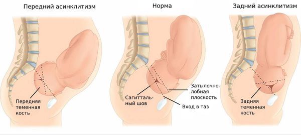 Асинклитическое вставление головки