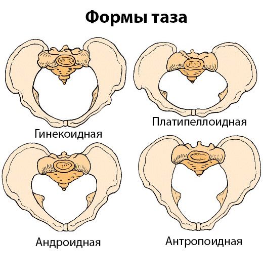 Формы таза согласно мировой классификации Galdwell — Moloy