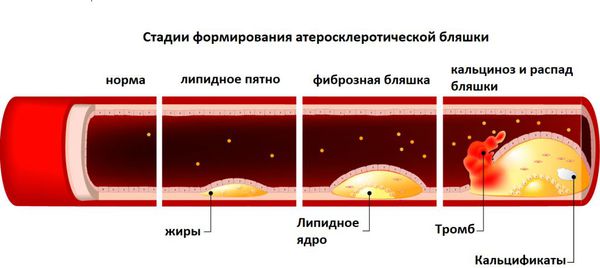 Формирование атеросклеротической бляшки