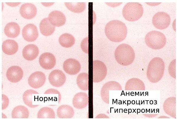 Эритроциты в норме и при анемии, макроцитозе и гиперхромии