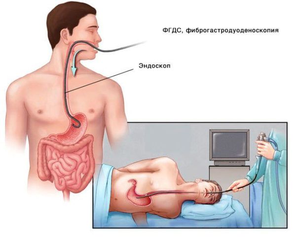 Фиброгастродуоденоскопия