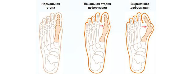 Деформация стопы