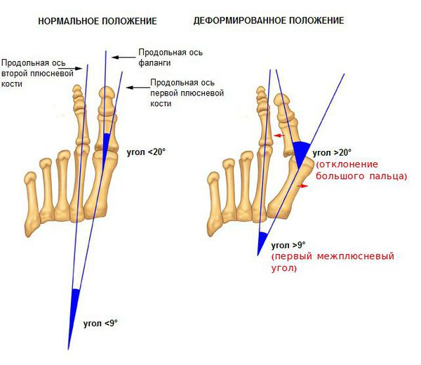 Нормальное и деформированное положение стопы