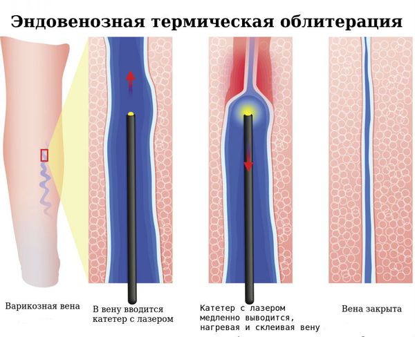 Эндовенозная термическая облитерация